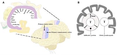 Surgical Management of Brain Metastases in the Perirolandic Region